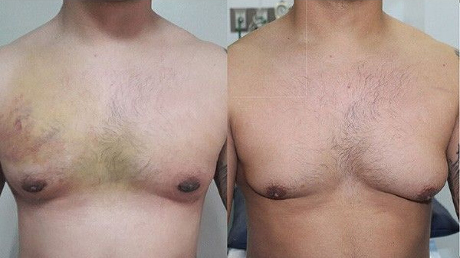 Gynecomastia