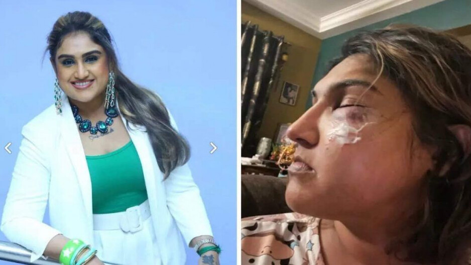 Brutally attack on  Vanitha Vijaykumar