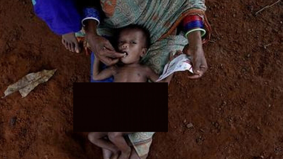 Malnutrition Affected Child