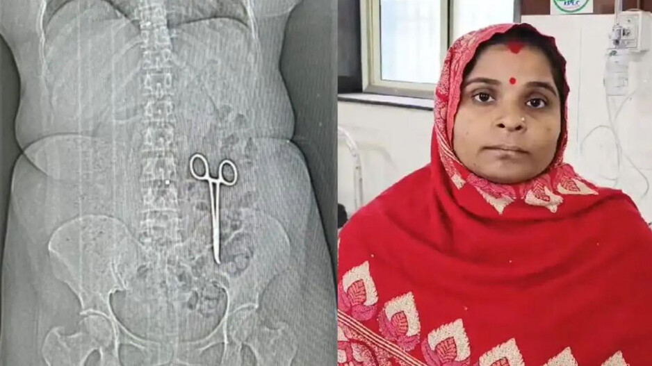 Kamala Bai and Scissor recovered from her stomach