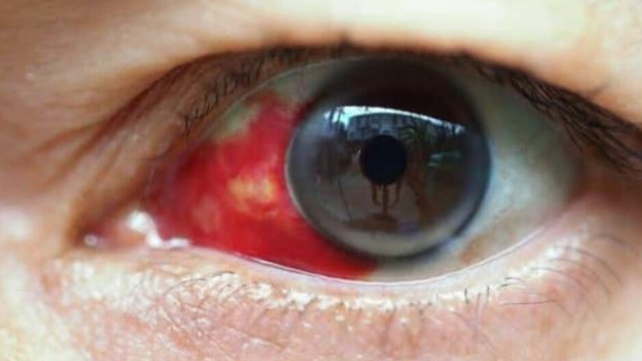 'Bleeding eye' virus (File Photo)