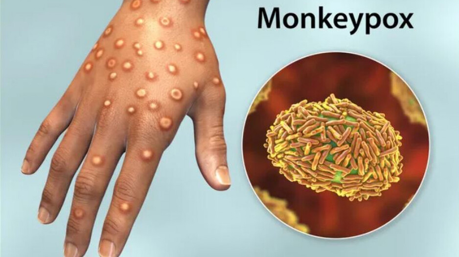 Monkeypox 