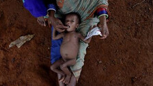 Malnutrition Affected Child