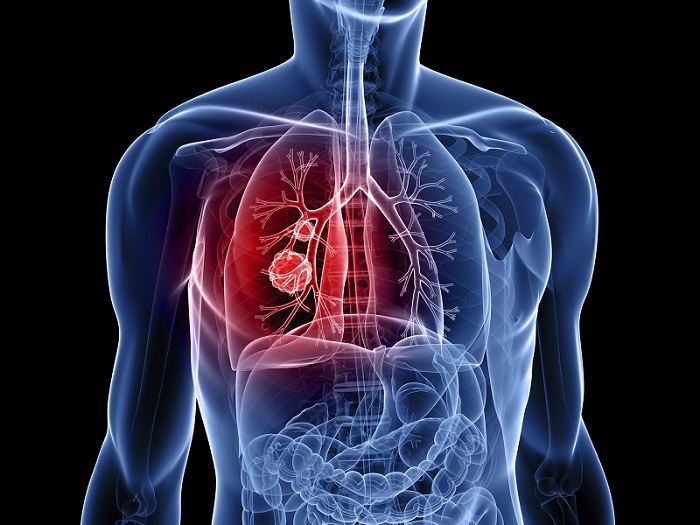 lung-cancer (1)