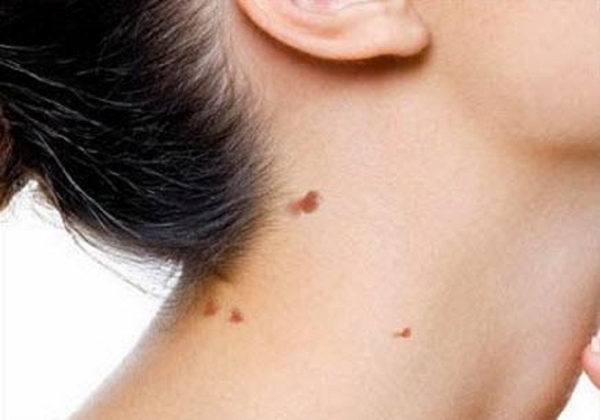 skin-tag-and-warts-removal